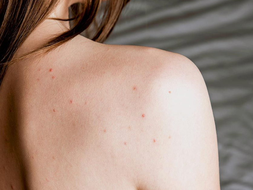 en rygg med akne